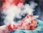 烟雾病手术大概多少钱