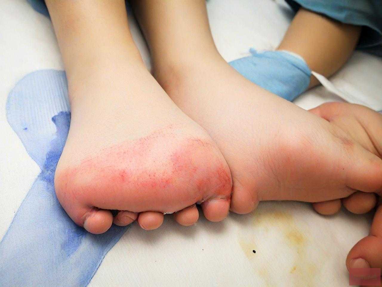 脚骨折大概要花多少钱